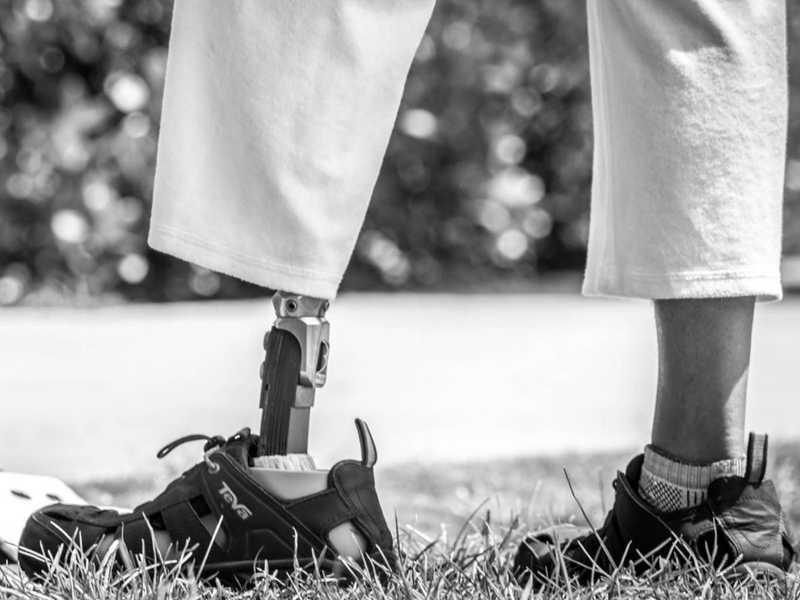 How I Stopped My Phantom Limb Pain