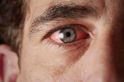 Why does smoking weed cause red bloodshot eyes?